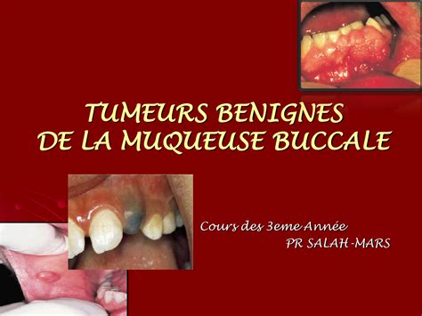 Tumeur De La Muqueuse Buccale