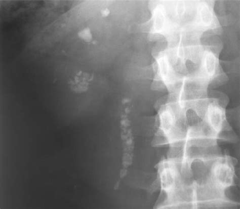 X Ray Showing Nephrocalcinosis With Calculi Filling The Upper Part Of