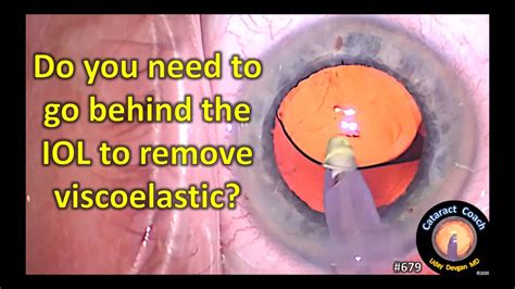 Should You Go Behind The IOL To Remove Viscoelastic In Cataract Surgery