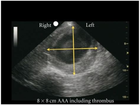 Abdominal Aorta Ultrasound