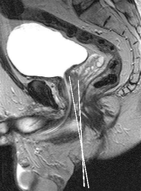 Mri Guided Prostate Brachytherapy With Single Needle Method—a Planning