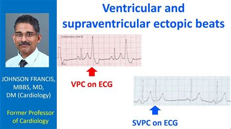 Ventricular and supraventricular ectopic beats - YouTube