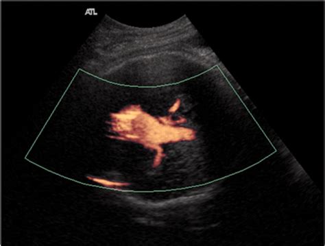 Prenatal Diagnosis Of Aneurysms Of The Vein Of Galen Vena Magna