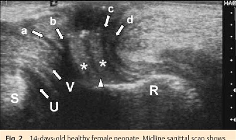 Figure From Transperineal Sonography Of The Anal Sphincter Complex In