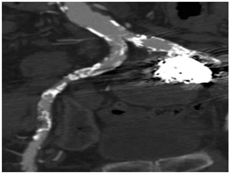 Embolization Of Large Internal Iliac Artery Pseudoaneurysm Through A