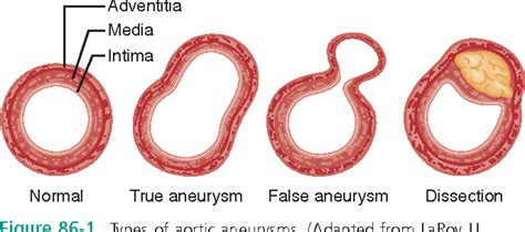 Abdominal Aortic Aneurysm Types