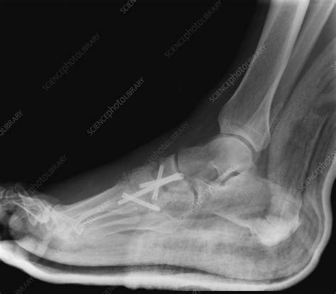 What Does Arthritis Look Like On X Ray Foot Sale Online