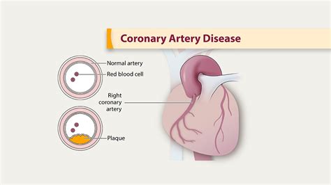 About Coronary Artery Disease (CAD) | Heart Disease | CDC