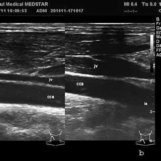 The Right Common Carotid Artery A Longitudinal View B Transverse