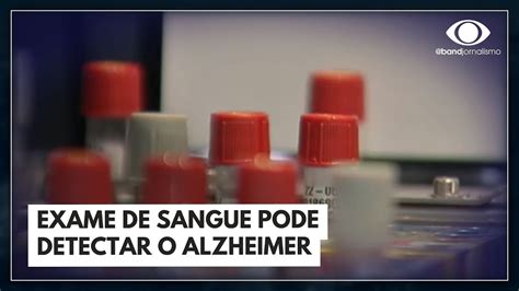 Exame De Sangue Detecta Doen A De Alzheimer Jornal Da Band Youtube