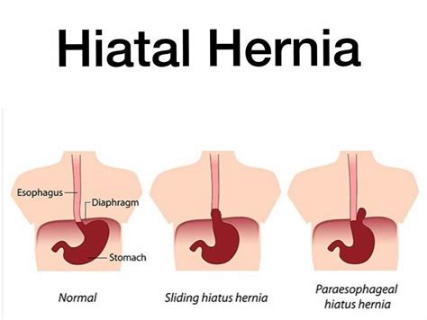 Hiatal Hernia