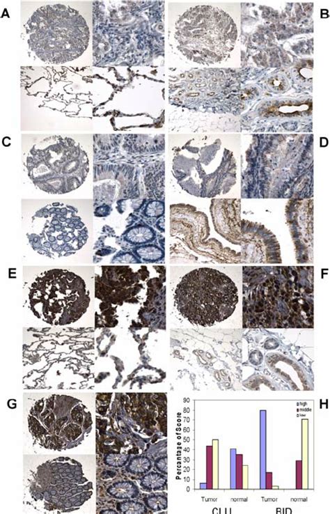 Clu And Bid Immunostaining In Tumor And Normal Tissues Positive