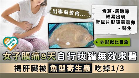 肝巨片形吸蟲︳女子脹痛8天自行拔罐無效求醫 揭肝臟被魚型寄生蟲吃掉13 晴報 健康 飲食與運動 D220305