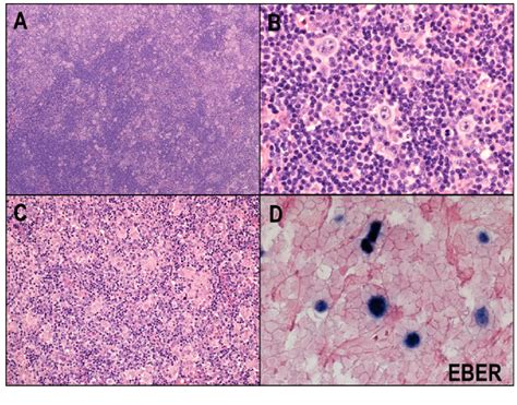 Figure From An Update On The Pathology And Molecular Features Of