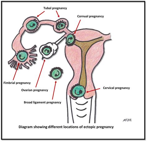 Ectopic Pregnancy Women S Health By Dr Lee Say Fatt