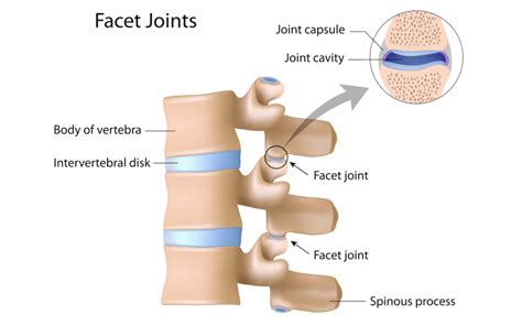 Facet joint syndrome - London Neurosurgery - Spine