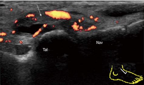 Synovitis of the talonavicular joint in psoriatic arthritis.... | Download Scientific Diagram