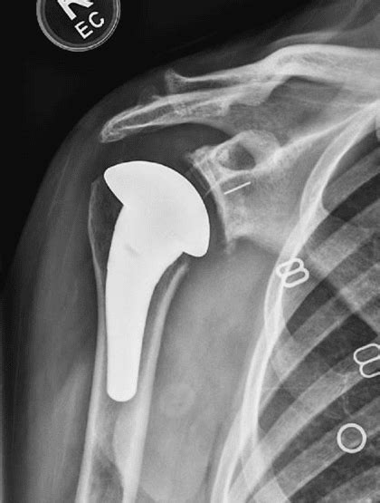 Shoulder Joint Replacement Midtown Atlanta GA Alpharetta GA