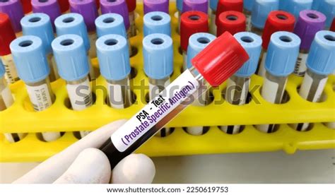 Blood Sample Psa Prostatespecific Antigen Test Stock Photo 2250619753