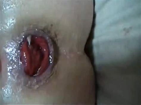 Pump Pron Amateur Fisting Kinky Mature Amateur Pumping Anal Hard And Sweet Ass Prolapse