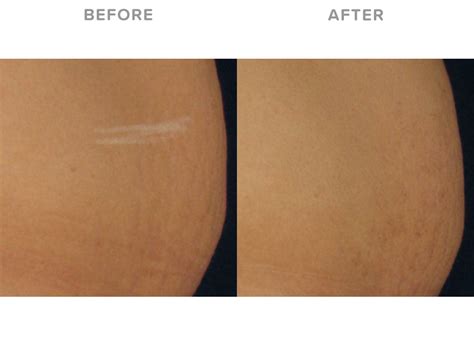 Stretch Mark Treatment Eden Laser Clinics