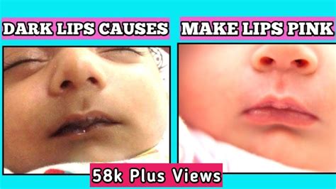 Baby Lips Black After Feeding The Causes Of Dark Lips In Babies How