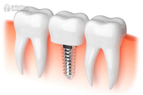 C Y Gh P Implant L G U V Nh C I M Khi C Y Gh P Implant B N C N Bi T