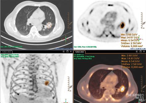 西安交大二附院petct开机啦！什么情况下需要做petct？看这里~~~新浪陕西新浪网