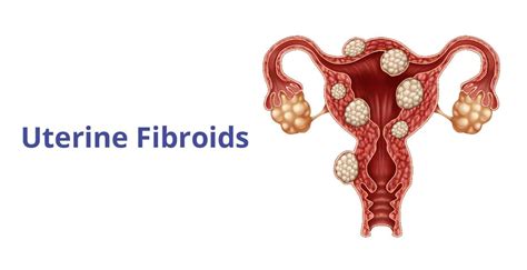 Uterine Fibroids Types