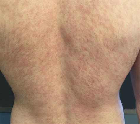 Maculopapular Rash Syphilis