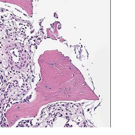 (a) Chest wall high grade soft tissue sarcoma. (b) Full-thickness ...