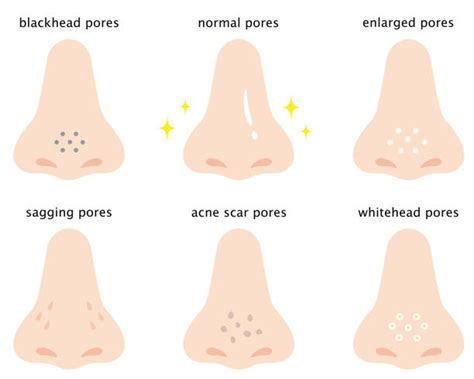 Enlarged Pores Nose