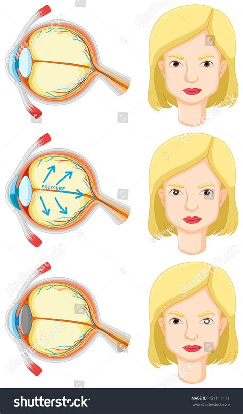 Diagram Showing Eye Problem Human Illustration Stock Vector (Royalty Free) 451111171 | Shutterstock