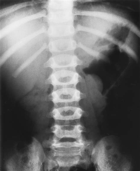 Intussusception In Children Current Concepts In Diagnosis And Enema