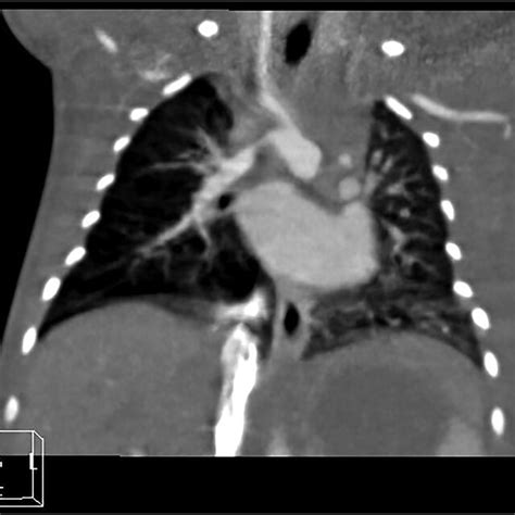 Right Proximal Interruption Of The Pulmonary Artery With Left Sided