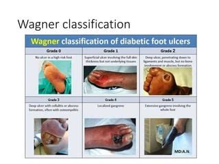 Journal Reading New Trends In Orthopaedic Management Of Diabetic Foot Pptx