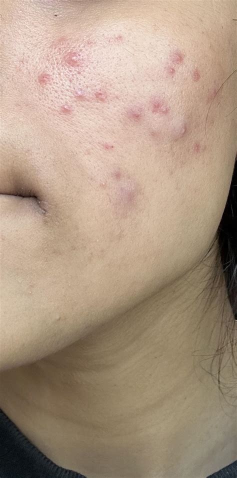 [Acne] cystic acne and scarring - help! : r/SkincareAddiction