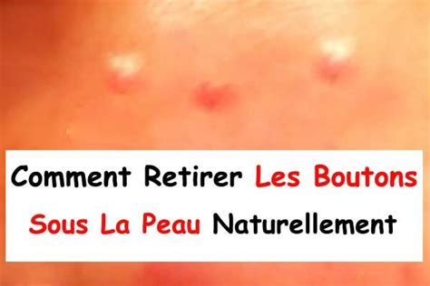 Comment Retirer Les Boutons Sous La Peau Naturellement La beauté