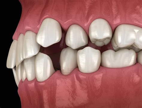 Dental Occlusion Images Search Images On Everypixel