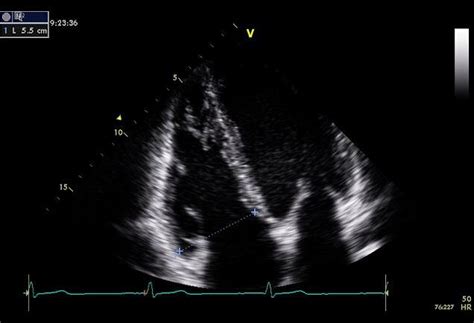 proximal rvot measurement  scientific diagram