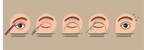 Blepharoplastik