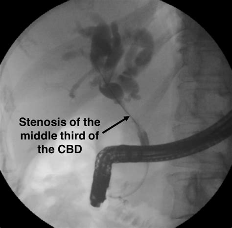 Cholangiographic View Showing An Irregular Stricture Of The Middle