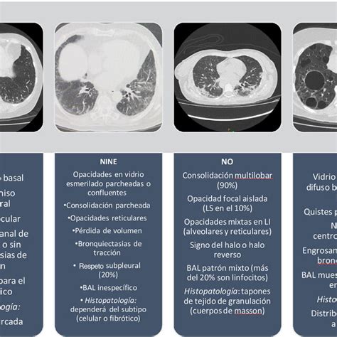 Clasificaci N De Las Neumon As Intersticiales Idiop Ticas Bal