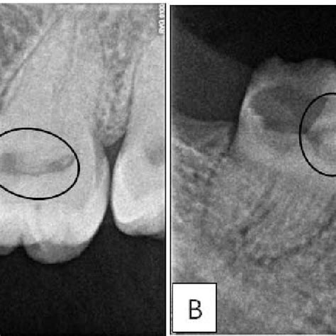 Periapical Radiograph Of The A Upper Left Molars And B Lower Right