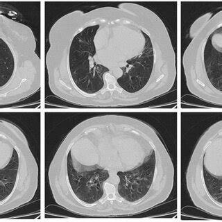 High resolution, axial non-enhanced spiral chest CT image (lung window)... | Download Scientific ...