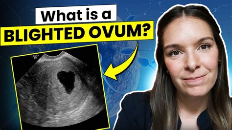 Understanding Blighted Ovum Signs Diagnosis And Management Youtube