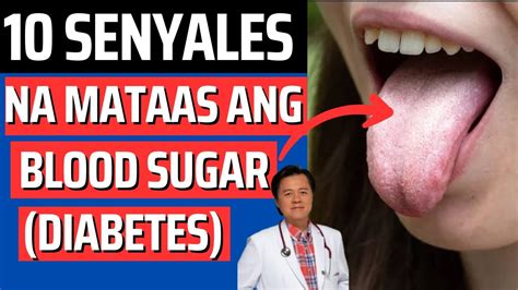 10 Senyales Na Mataas Ang Blood Sugar Diabetes By Doc Willie Ong