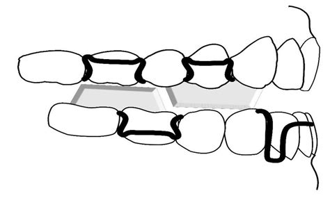 Schematic view of Reverse Twin Block Appliance. | Download Scientific ...