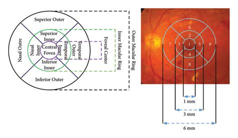 Early Treatment Of Diabetic Retinopathy Study Etdrs Grid Of A The