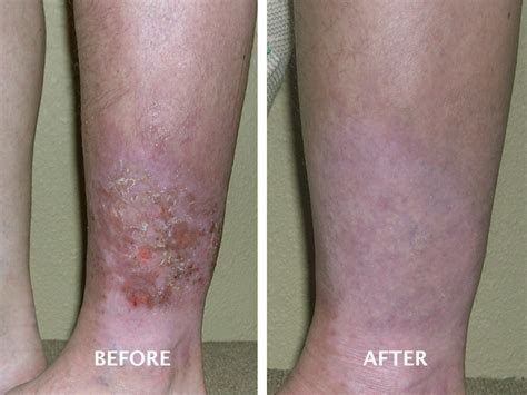 Venous Ulcer Before And After